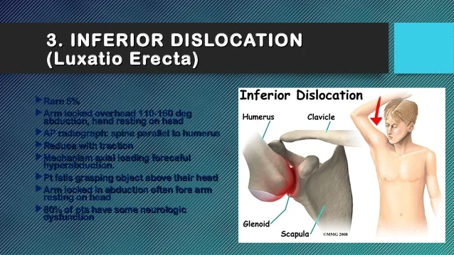 03 shoulder dislocation 33 638