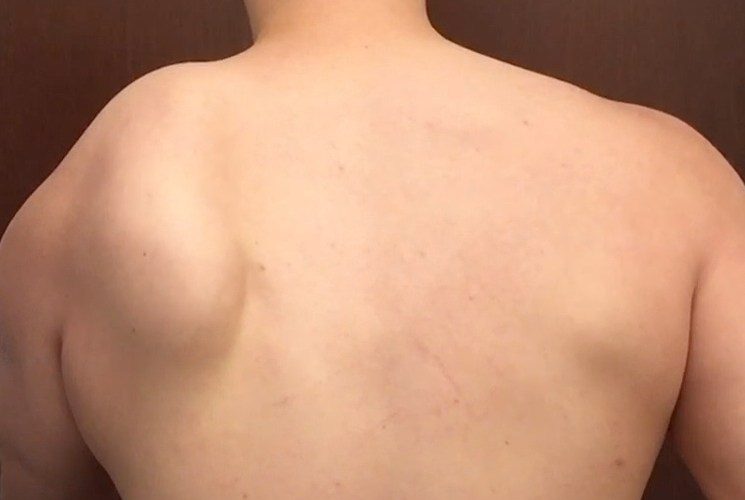 10.Scapular winging 745x500
