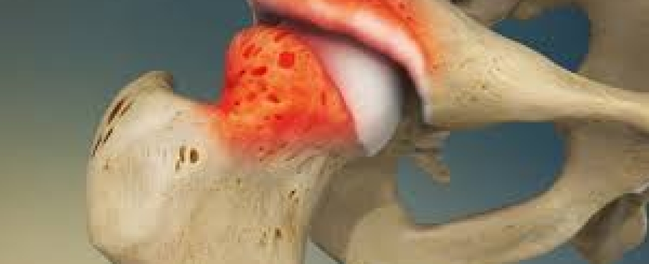 Femoroacetabular Impingement