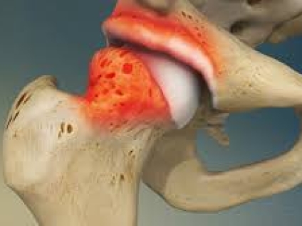 Femoroacetabular Impingement