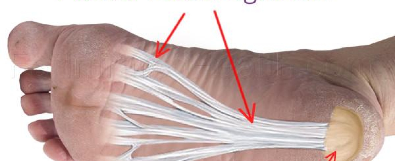 Plantar Fasciitis