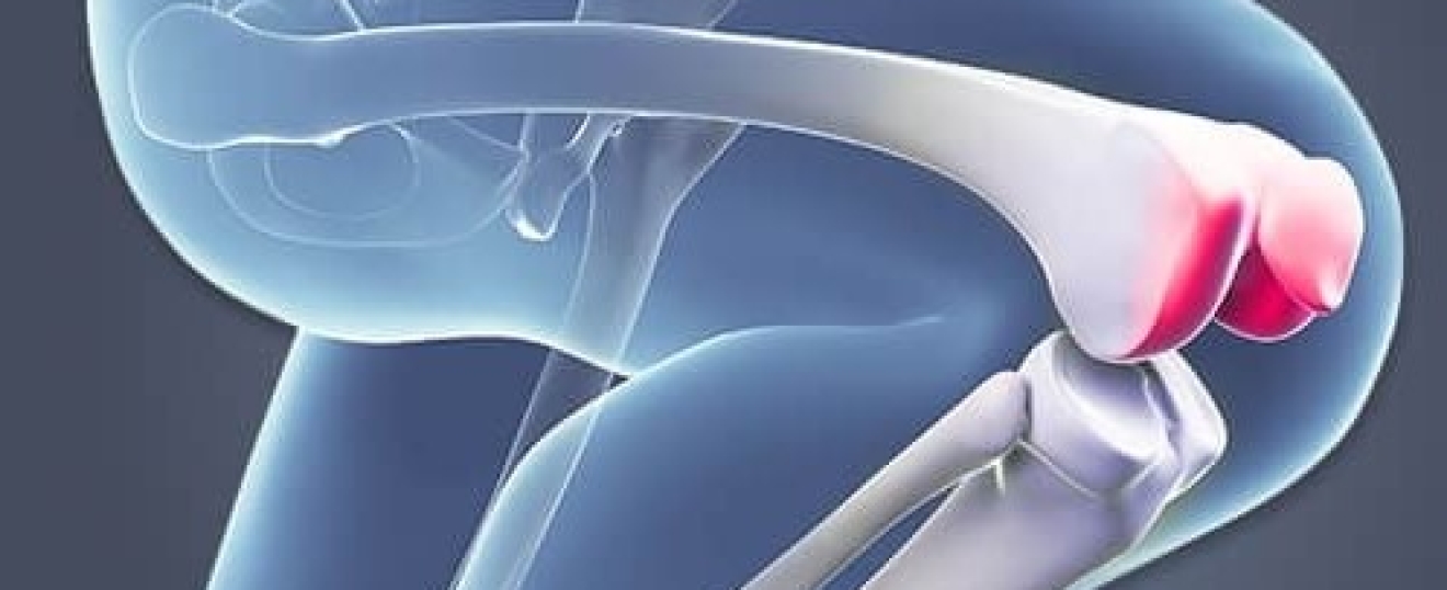 Patellofemoral Syndrome (Runners Knee)