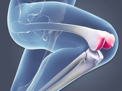 Patellofemoral Syndrome (Runners Knee)