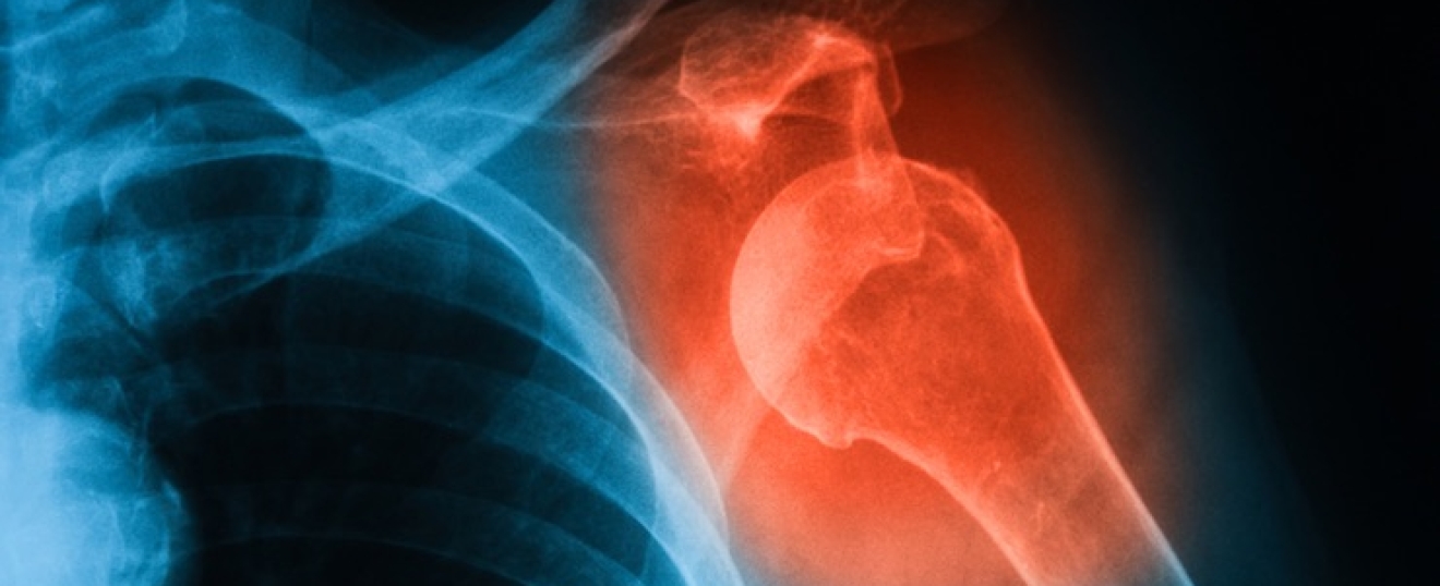 Shoulder Dislocation