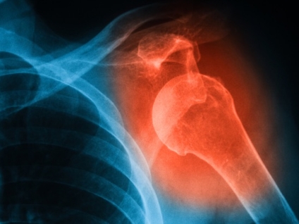 Shoulder Dislocation