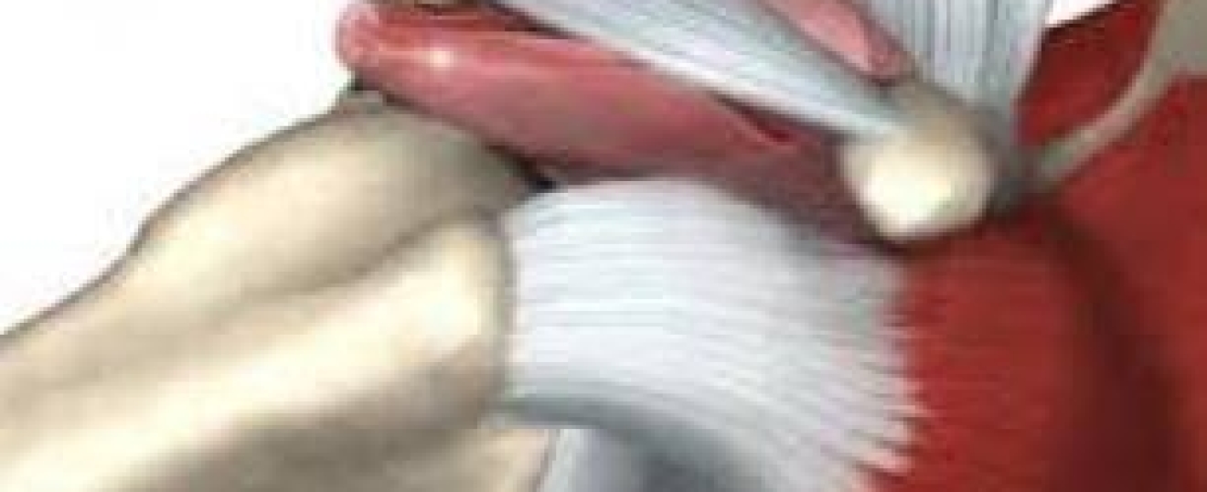 Shoulder Impingement