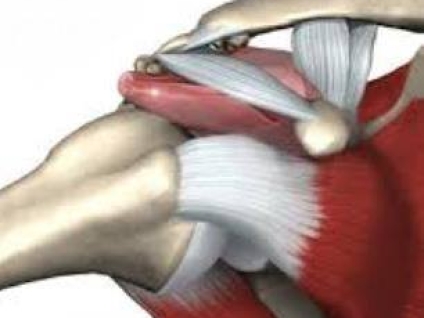 Shoulder Impingement
