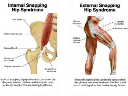 Snapping Hip Syndrome