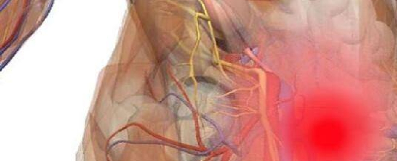 Gilmores Groin (Sports Hernia)