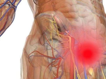 Gilmores Groin (Sports Hernia)