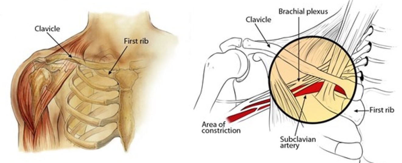 Thoracic Outlet Syndrome