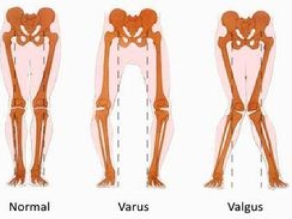 Knee Valgus Versus Varus