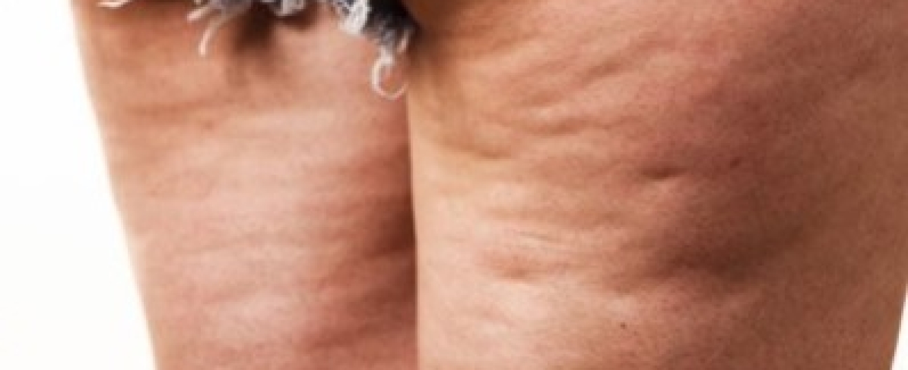 Massage for Cellulite