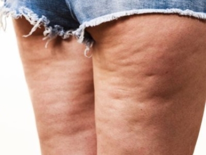 Massage for Cellulite
