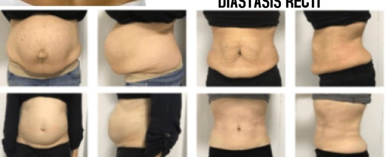 Abdomninal Diastasis
