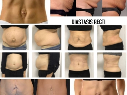 Abdomninal Diastasis