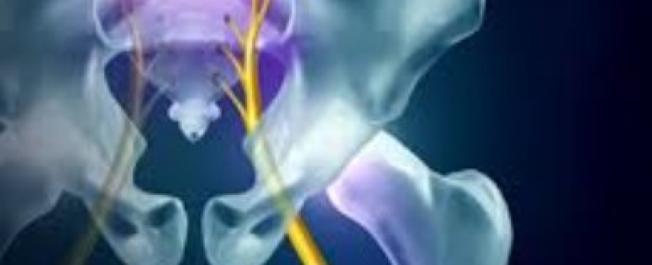 Deep Gluteal Syndrome