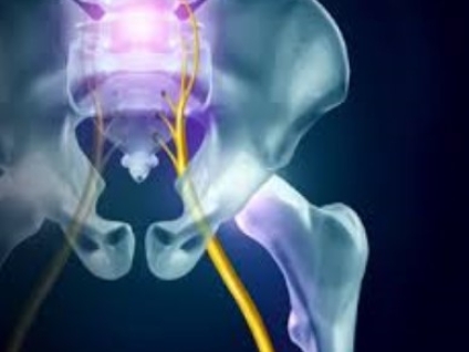 Deep Gluteal Syndrome