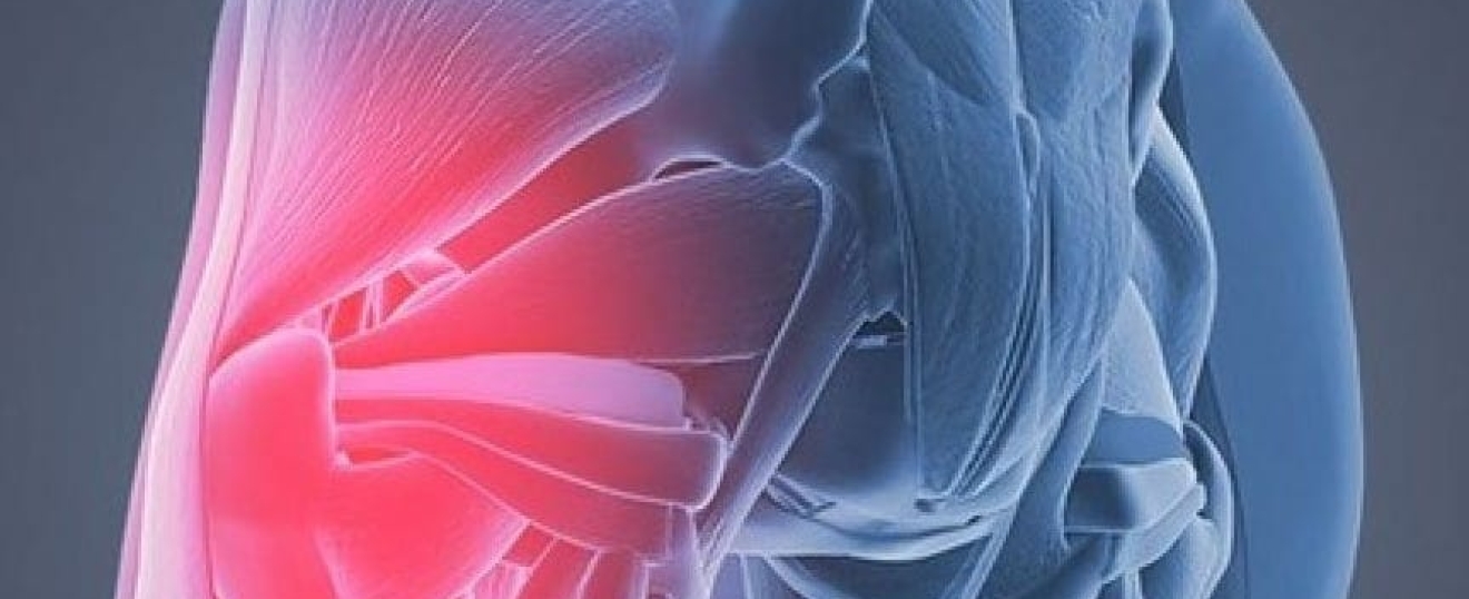 Gluteal Tendinopathy