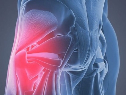 Gluteal Tendinopathy