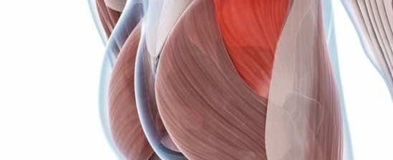 Gluteus Medius Tear