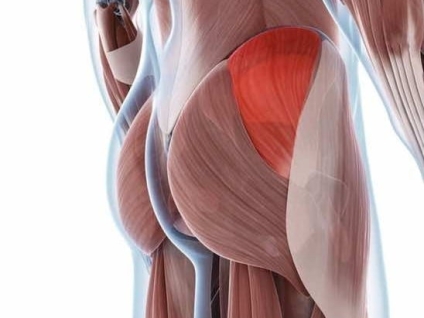 Gluteus Medius Tear