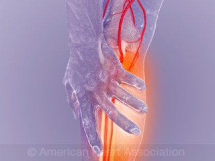 Massage for Peripheral Artery Disease