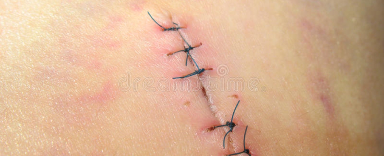 Post-surgical Massage