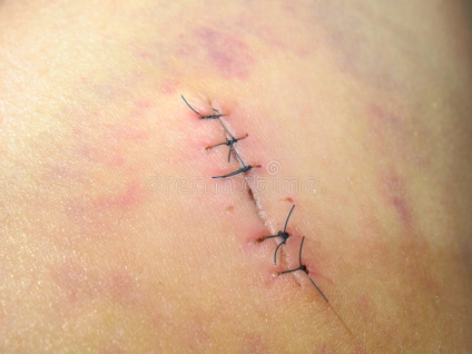 Post-surgical Massage