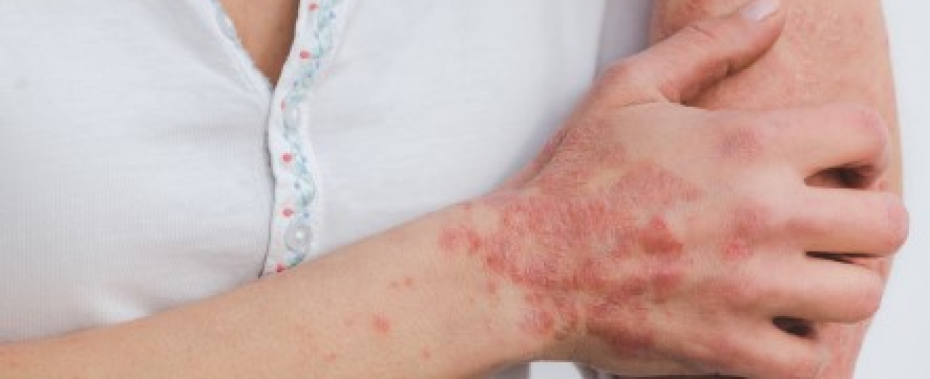 Massage for Psoriasis