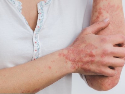 Massage for Psoriasis