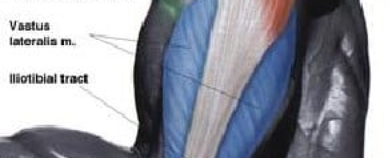 Gluteus Medius Syndrome (Runners Butt)