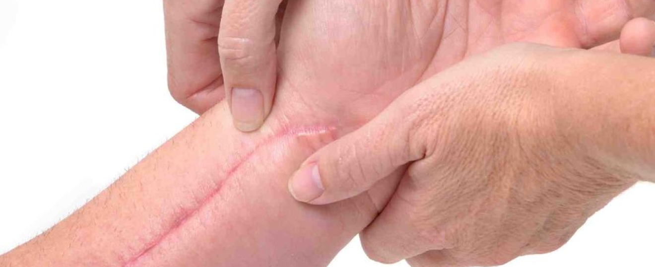 How Massage Can Be Used on Scar Tissue