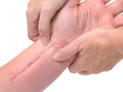 How Massage Can Be Used on Scar Tissue