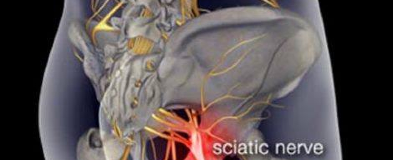 Massage for Sciatica