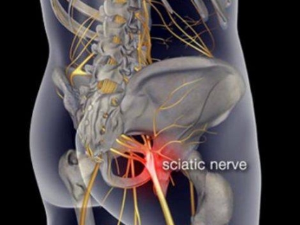 Massage for Sciatica