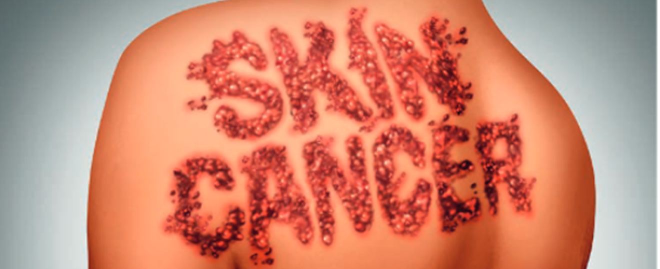 Melanoma and Skin Cancers