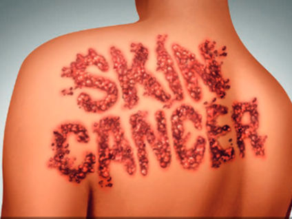 Melanoma and Skin Cancers