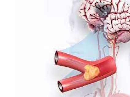 Massage Following Stroke