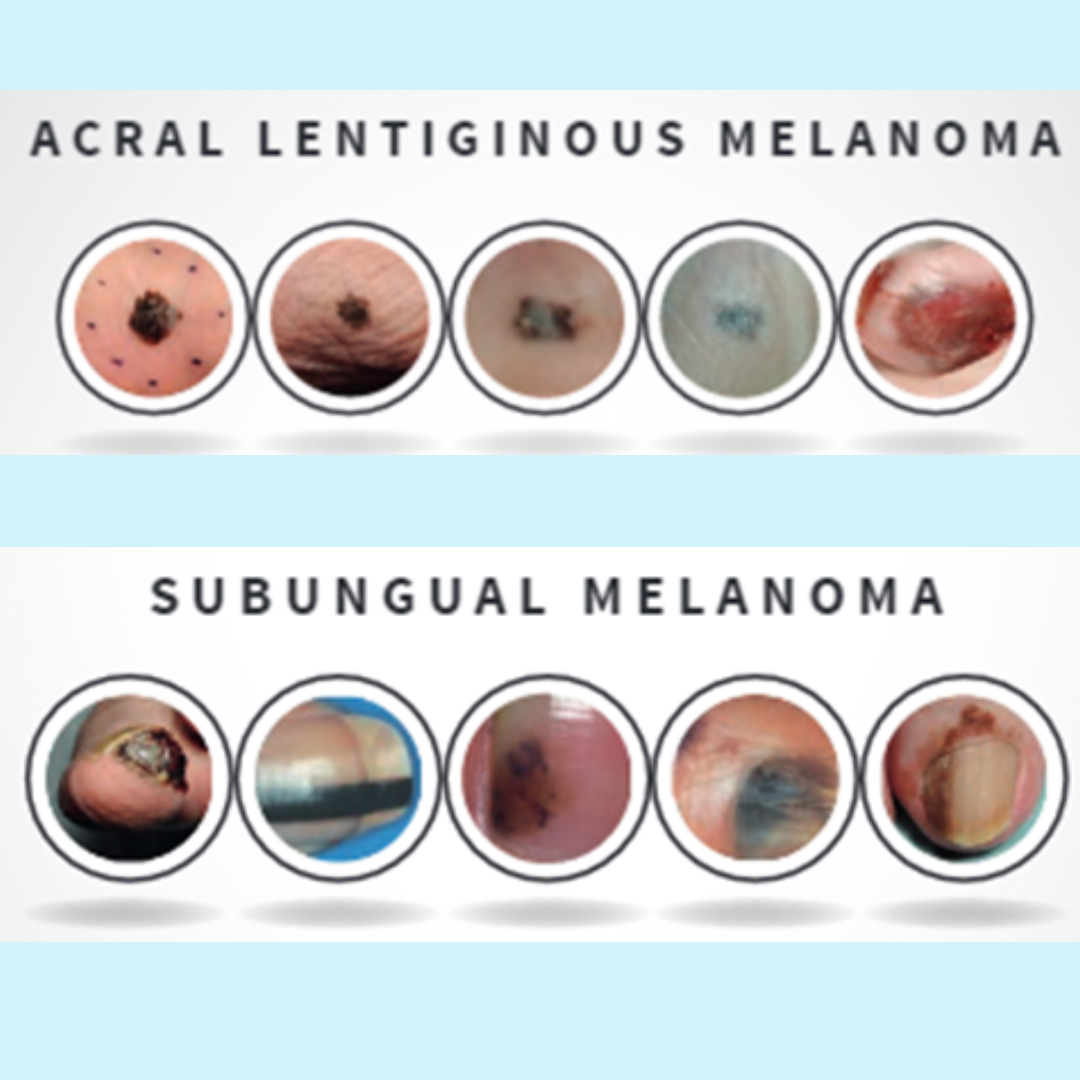 acralsubungualmelanoma