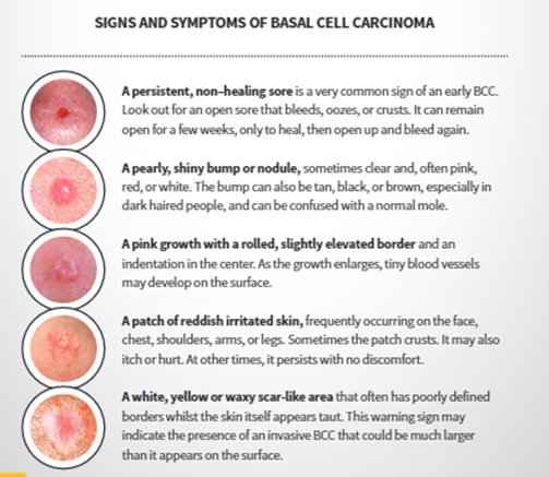 basalcellcarcinoma