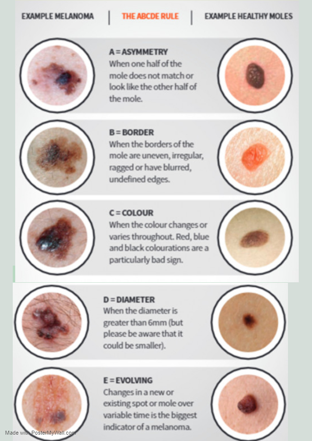 melanoma