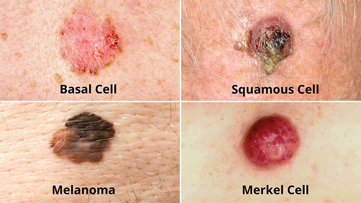 melanomatypes