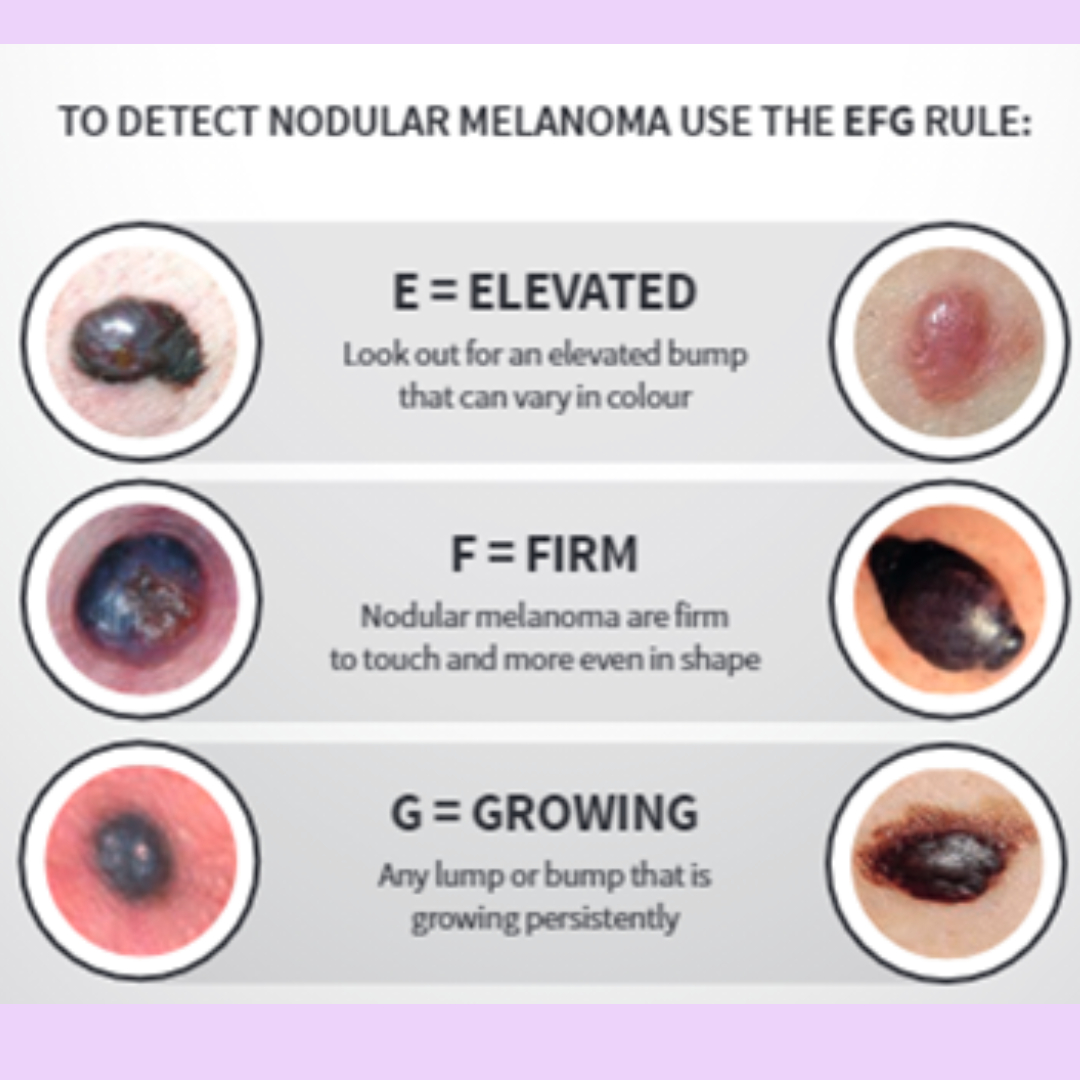 nodularmelanoma