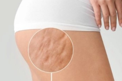 Cellulite Massage