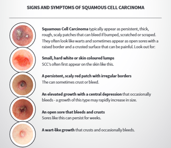 squamouscellcarinoma