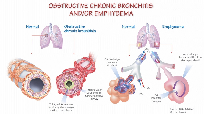 COPD3