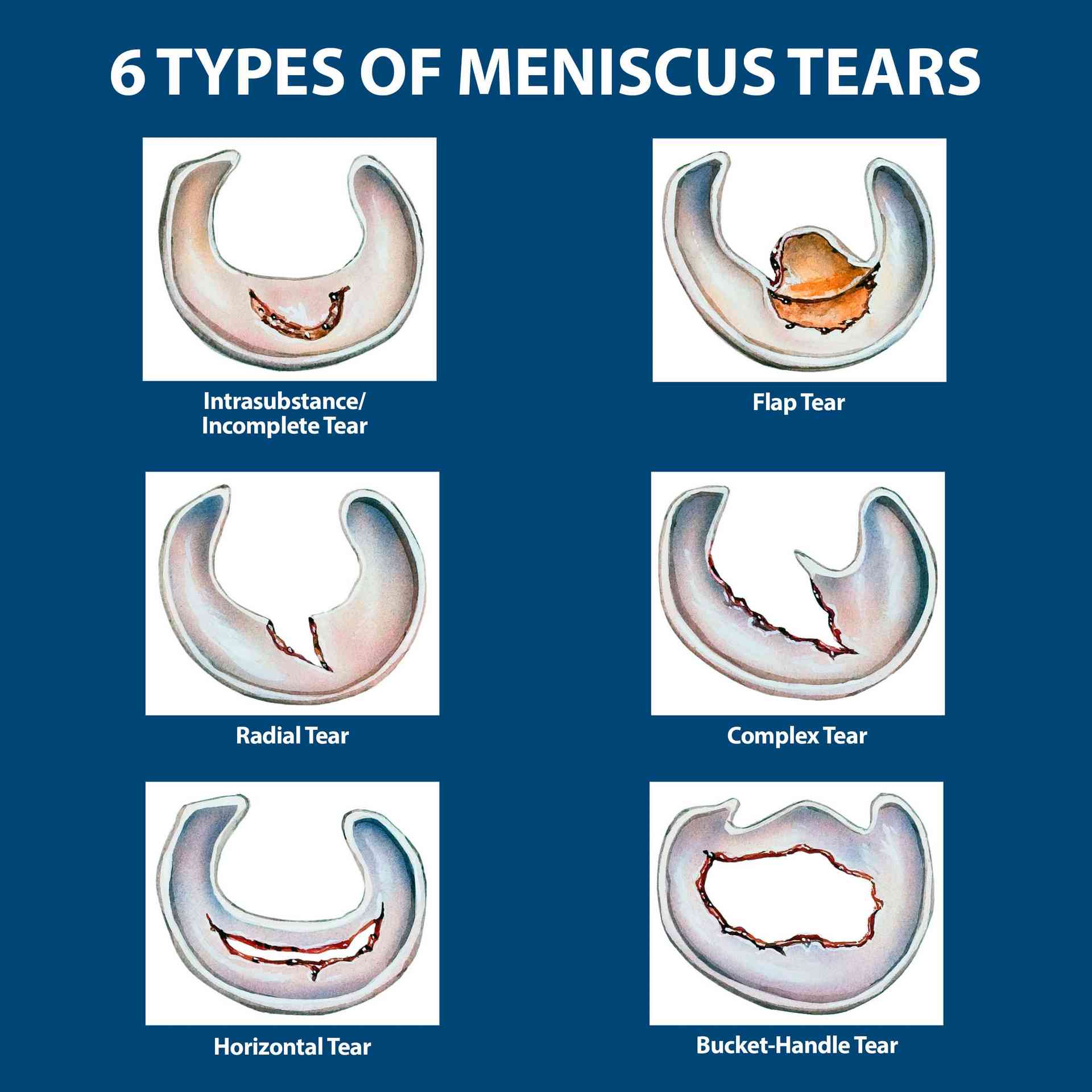 Meniscus Tear Graphic 2 2