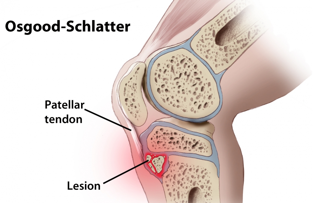 Osgood Schlatter 2