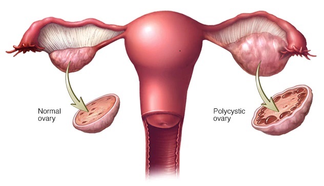 PCOS3